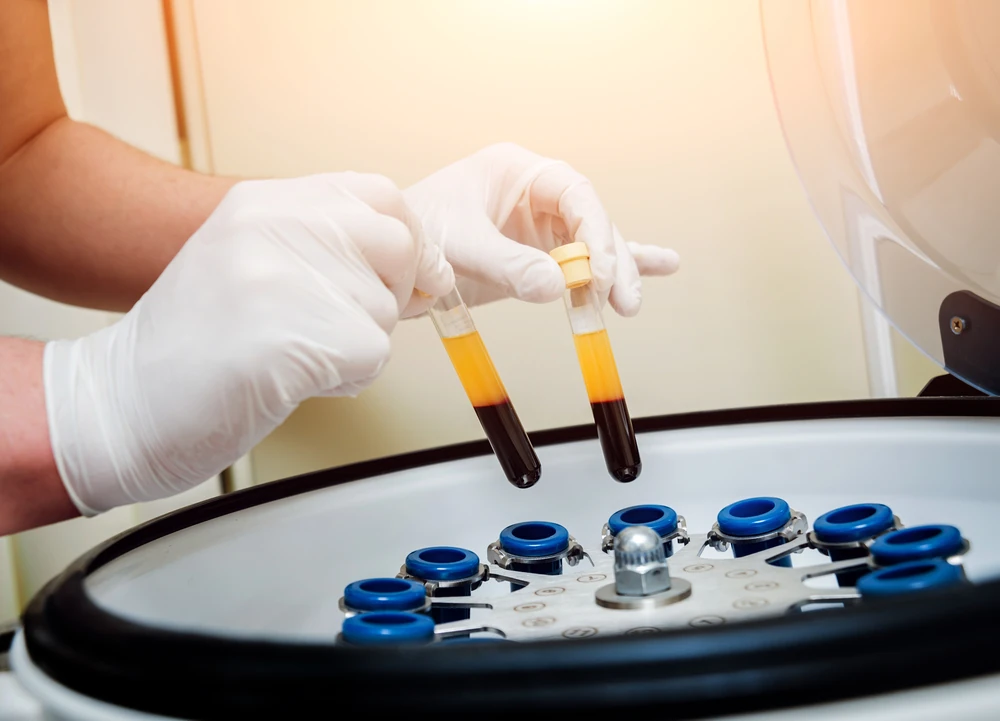 Photograph of blood specimen tubes next to a PRP centrifuge during platelet-rich plasma preparation